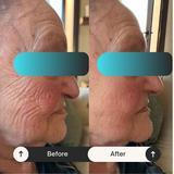 تونفيس™بوتوكس عيني