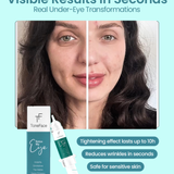 تونفيس™بوتوكس عيني